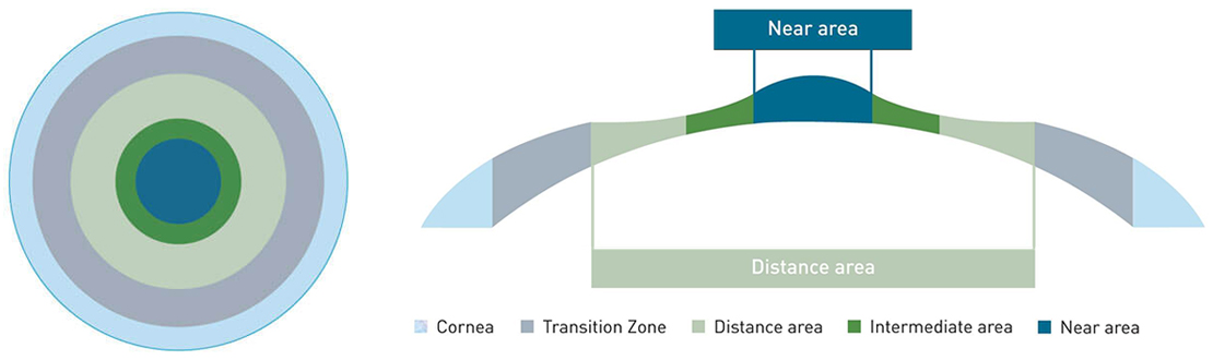 노안교정수술 방법-Cornea/Transition Zone/Distance area/Intermediate area/Near area