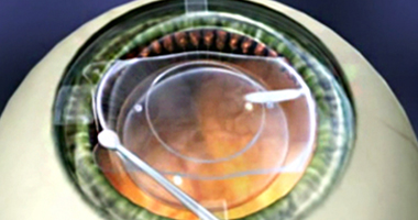 안내삽입렌즈, EVO + 아쿠아 ICL 수술 과정 이미지